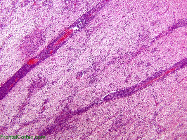 Primary CNS lymphoma, cerebral peduncle and midbrain, H&E stain x 40